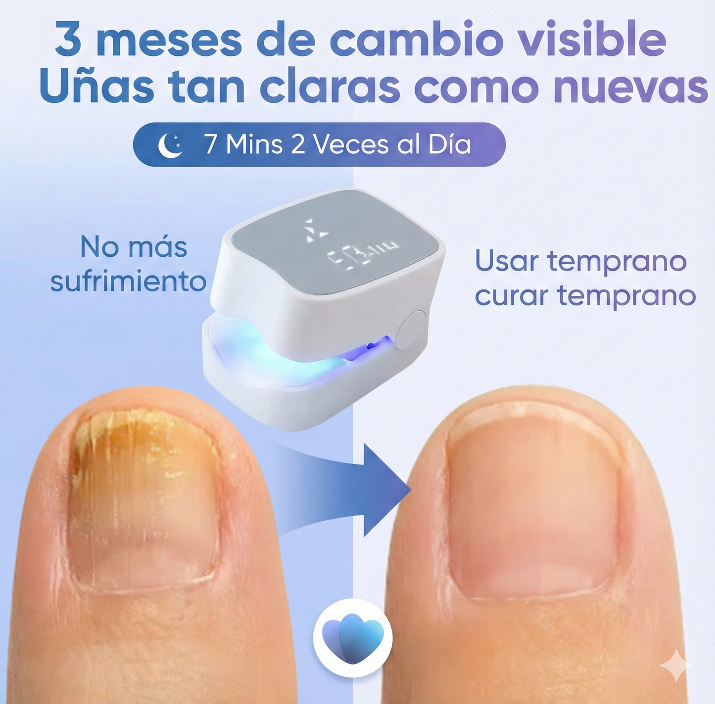 Láser Clean Nail – Tratamiento para hongos en las uñas